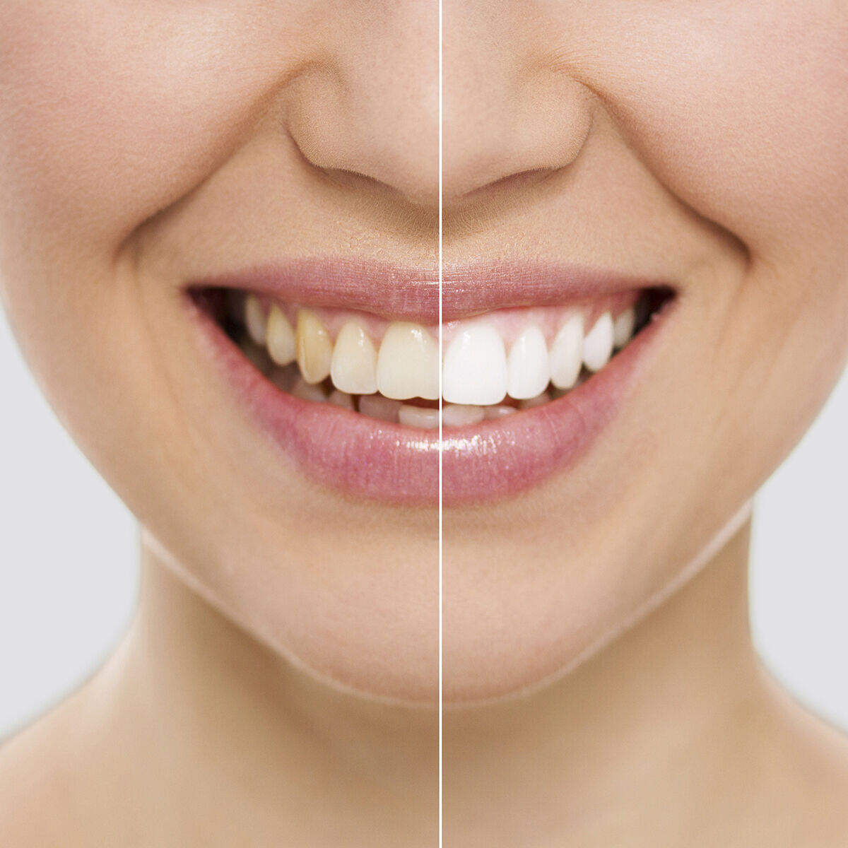 Kit Completo BlanqueadorPro™ Dentales